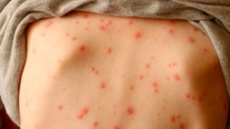 Khởi bệnh thủy đậu với các nốt ban nhỏ cũng bắt đầu xuất hiện