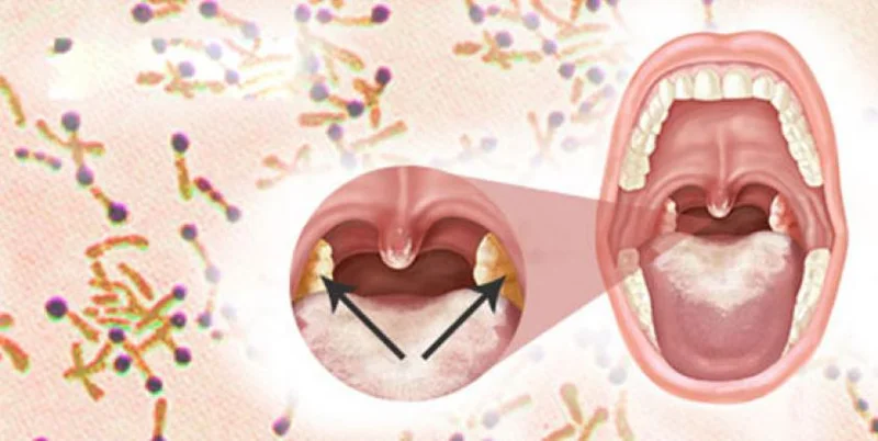 Giả mạc xuất hiện làm cho bệnh nhân bị bạch hầu khó thở, khó nuốt