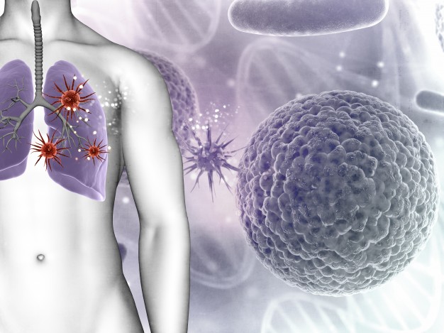 Nguyên nhân nào dẫn đến ung thư phổi?