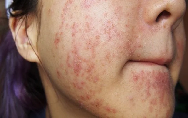 Mụn trứng cá cụm