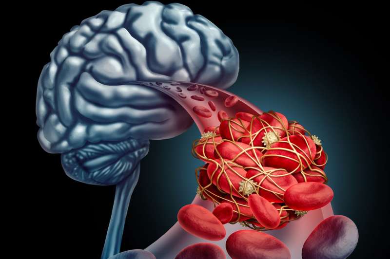 Đột quỵ liên quan đến sự suy giảm đột ngột lượng máu hoặc oxy đến não