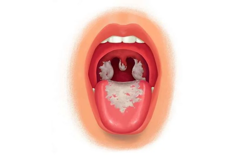 Bệnh bạch hầu có các biểu hiện nào?