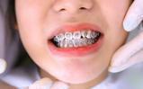 TOP 4 Địa chỉ niềng răng nổi tiếng nhất tại TP HCM