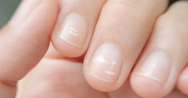 Móng tay bị đốm trắng - Biểu hiện của thiếu kẽm