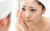 TOP 5 Sản phẩm trị mụn hiệu quả nhất loại bỏ mặt mụn