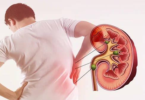 Đi tiểu nhiều lần, tiểu nhỏ giọt - Dấu hiệu của bệnh sỏi thận