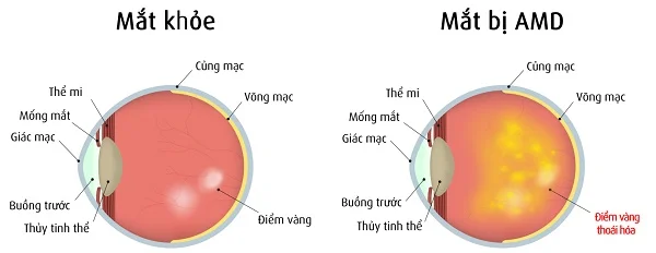 Thoái hóa điểm vàng
