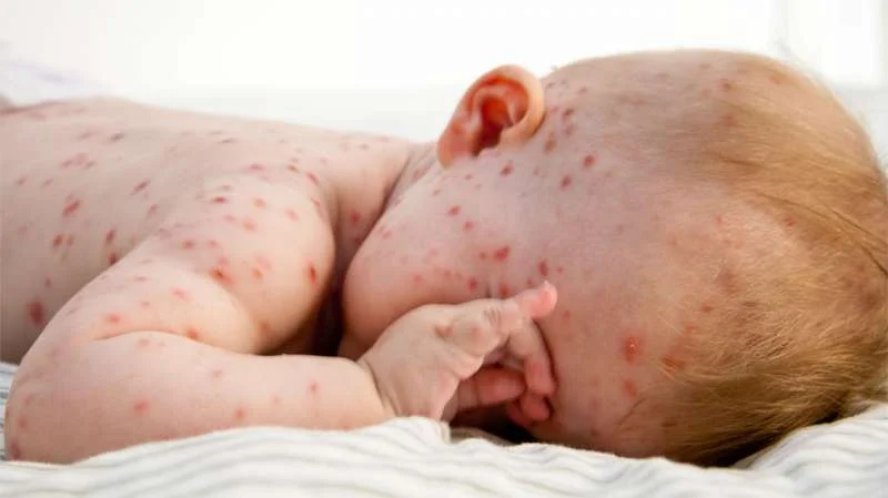 Khi mắc bệnh thủy đậu cần lưu ý điều gì?