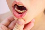 TOP 10 Cách trị nhiệt miệng hiệu quả ngay tại nhà